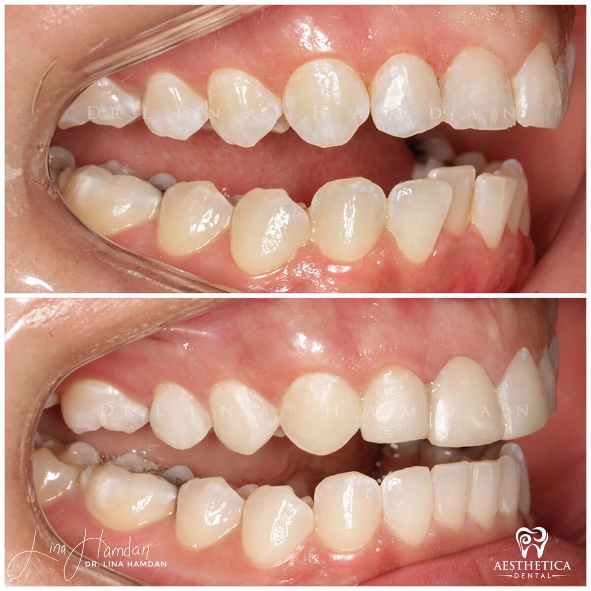 Inman aligners: anonymous case 13 from Aesthetica Dental Naperville