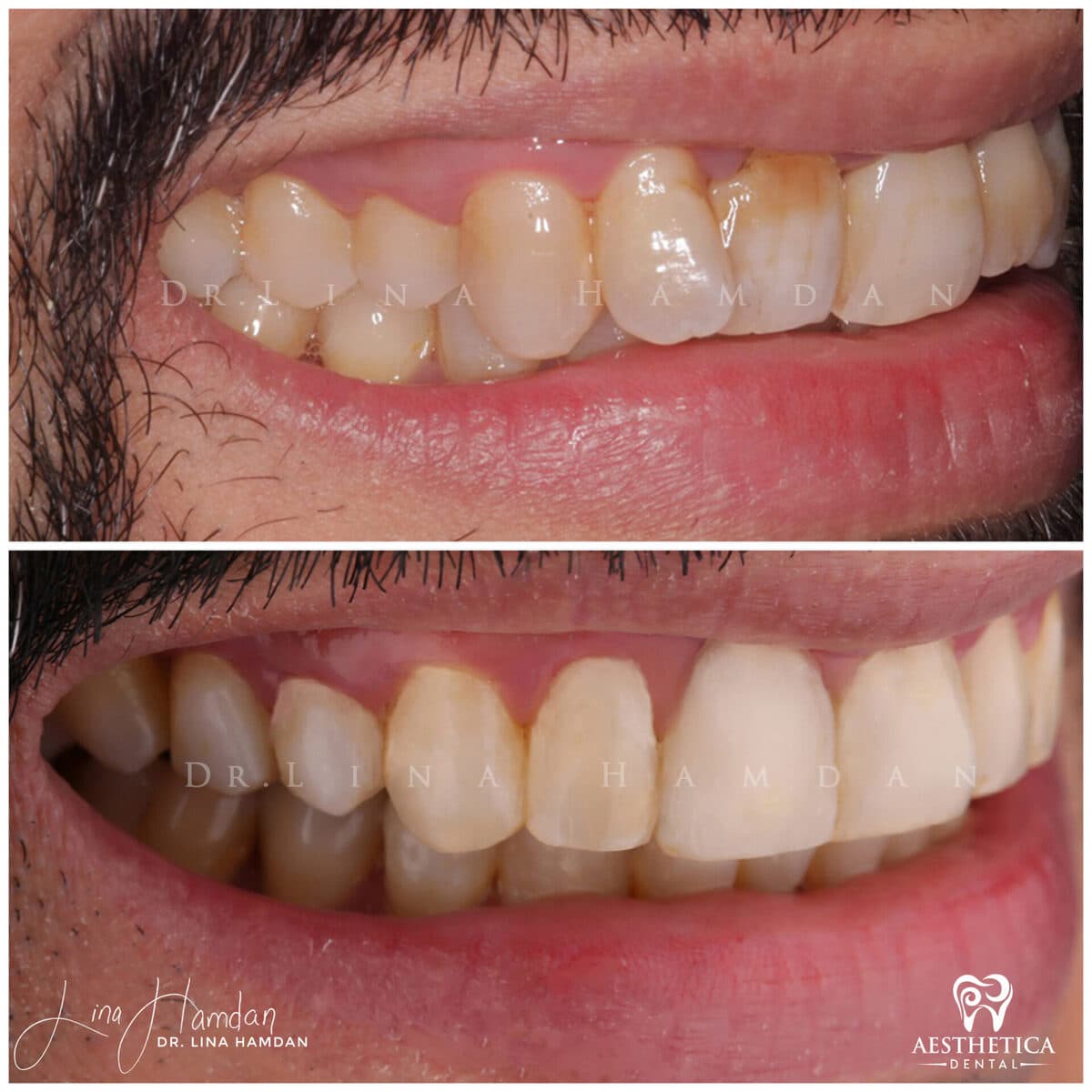 Inman aligners: anonymous case 14 from Aesthetica Dental Naperville