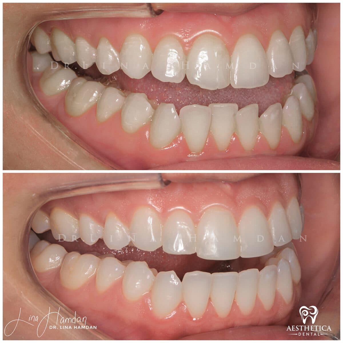 Inman aligners: anonymous case 16 from Aesthetica Dental Naperville