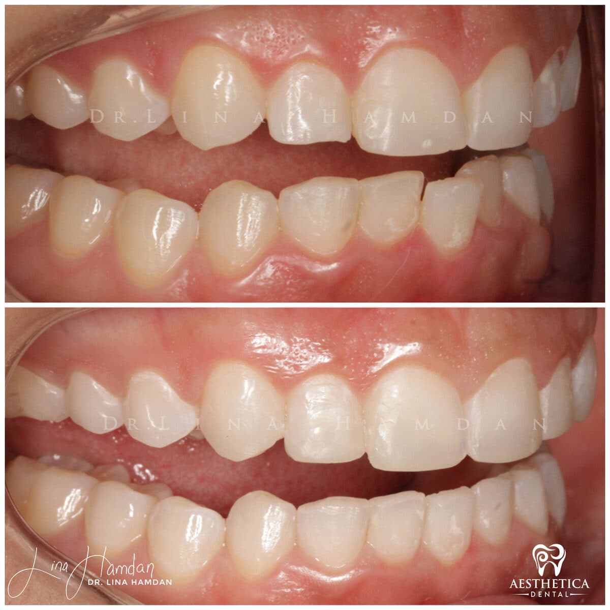 Inman aligners: anonymous case 17 from Aesthetica Dental Naperville