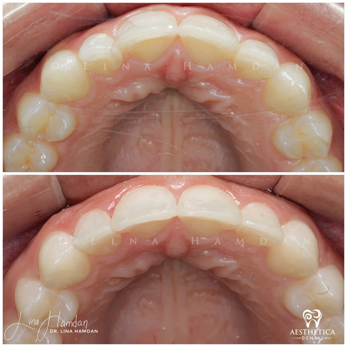 Inman aligners: anonymous case 20 from Aesthetica Dental Naperville