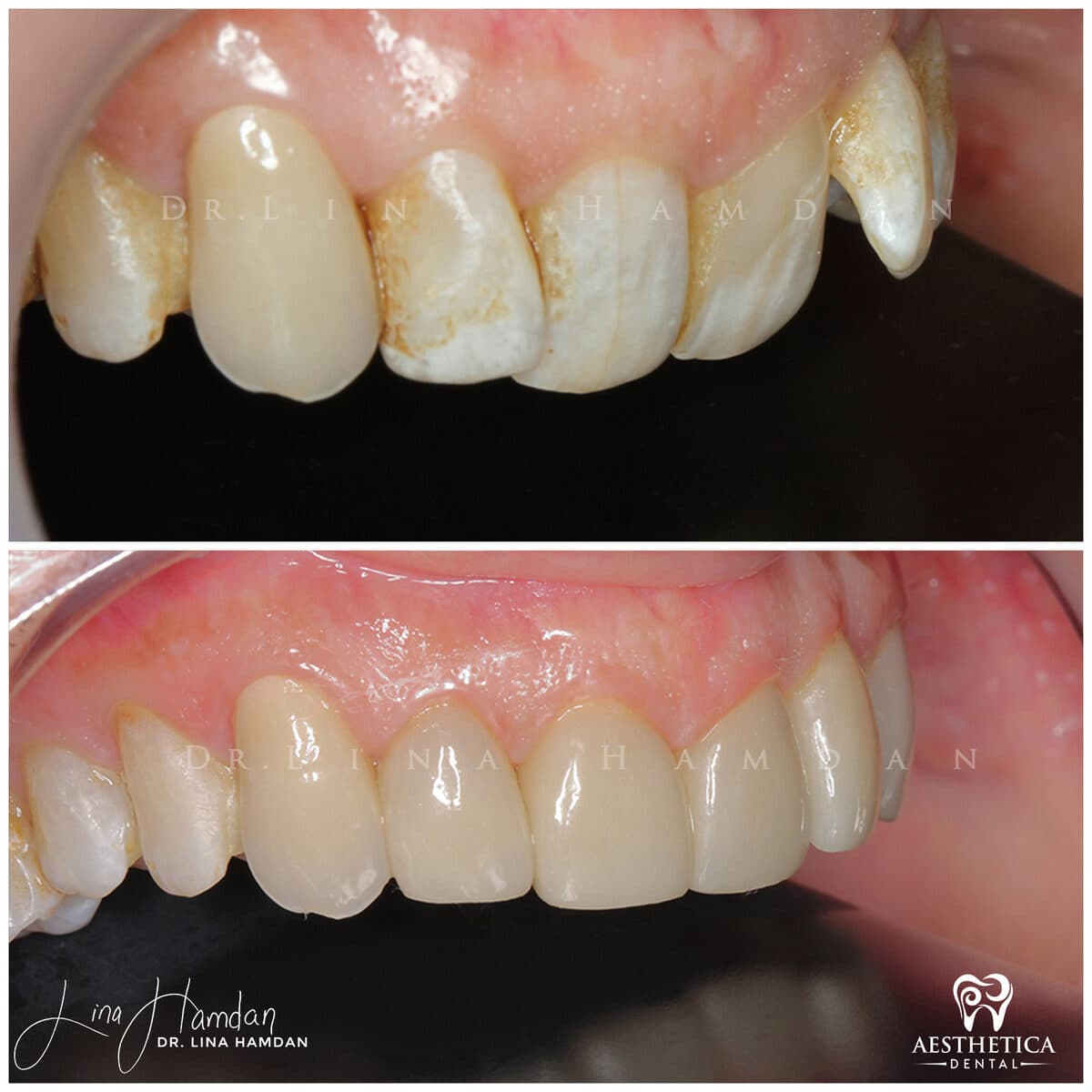 Inman aligners: anonymous case 21 from Aesthetica Dental Naperville