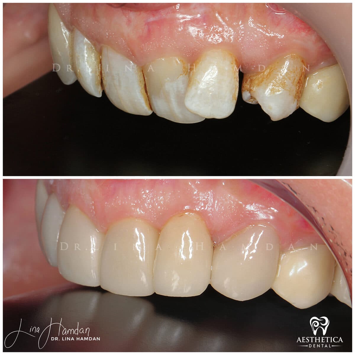 Inman aligners: anonymous case 22 from Aesthetica Dental Naperville
