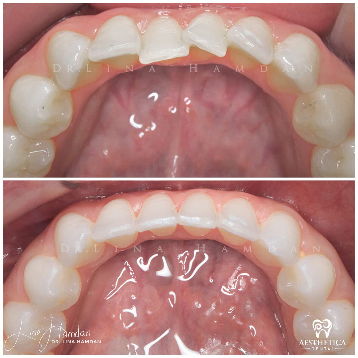 Inman aligners: anonymous case 23 from Aesthetica Dental Naperville