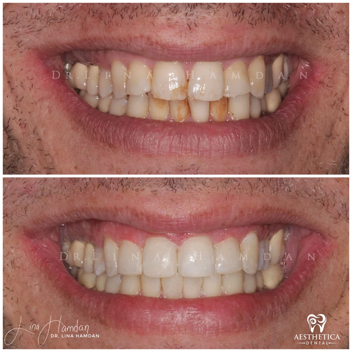 Inman aligners: anonymous case 25 from Aesthetica Dental Naperville