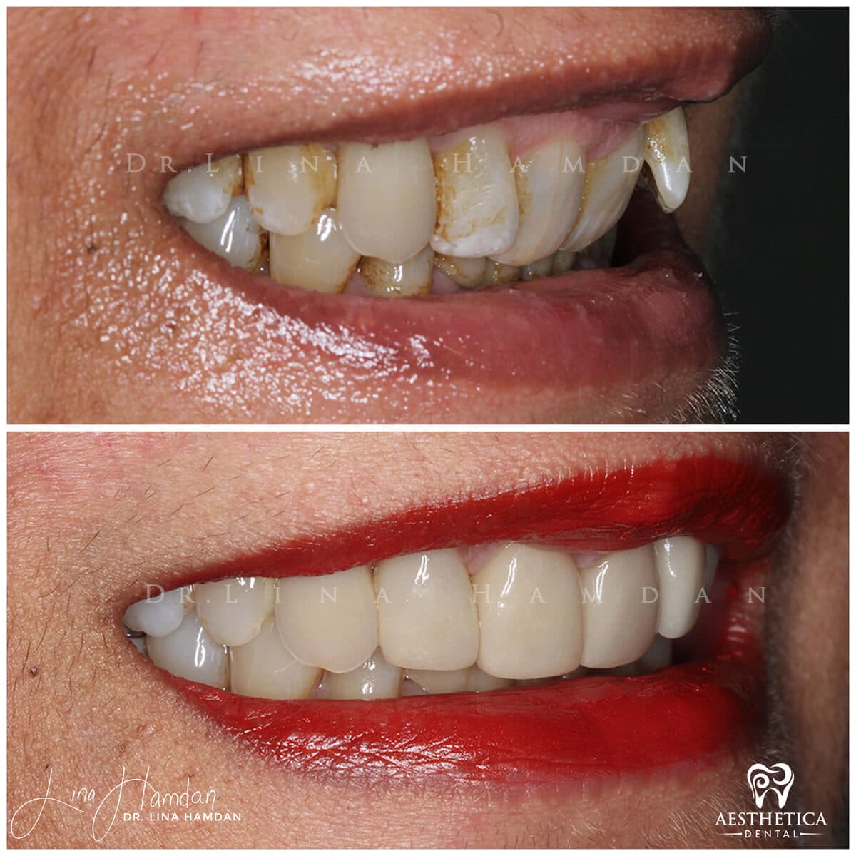Inman aligners: anonymous case 28 from Aesthetica Dental Naperville