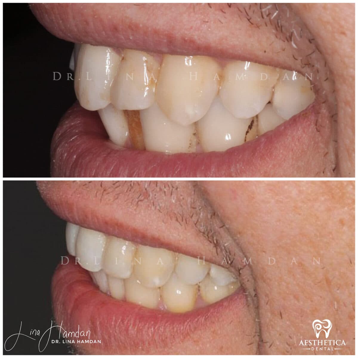 Inman aligners: anonymous case 33 from Aesthetica Dental Naperville