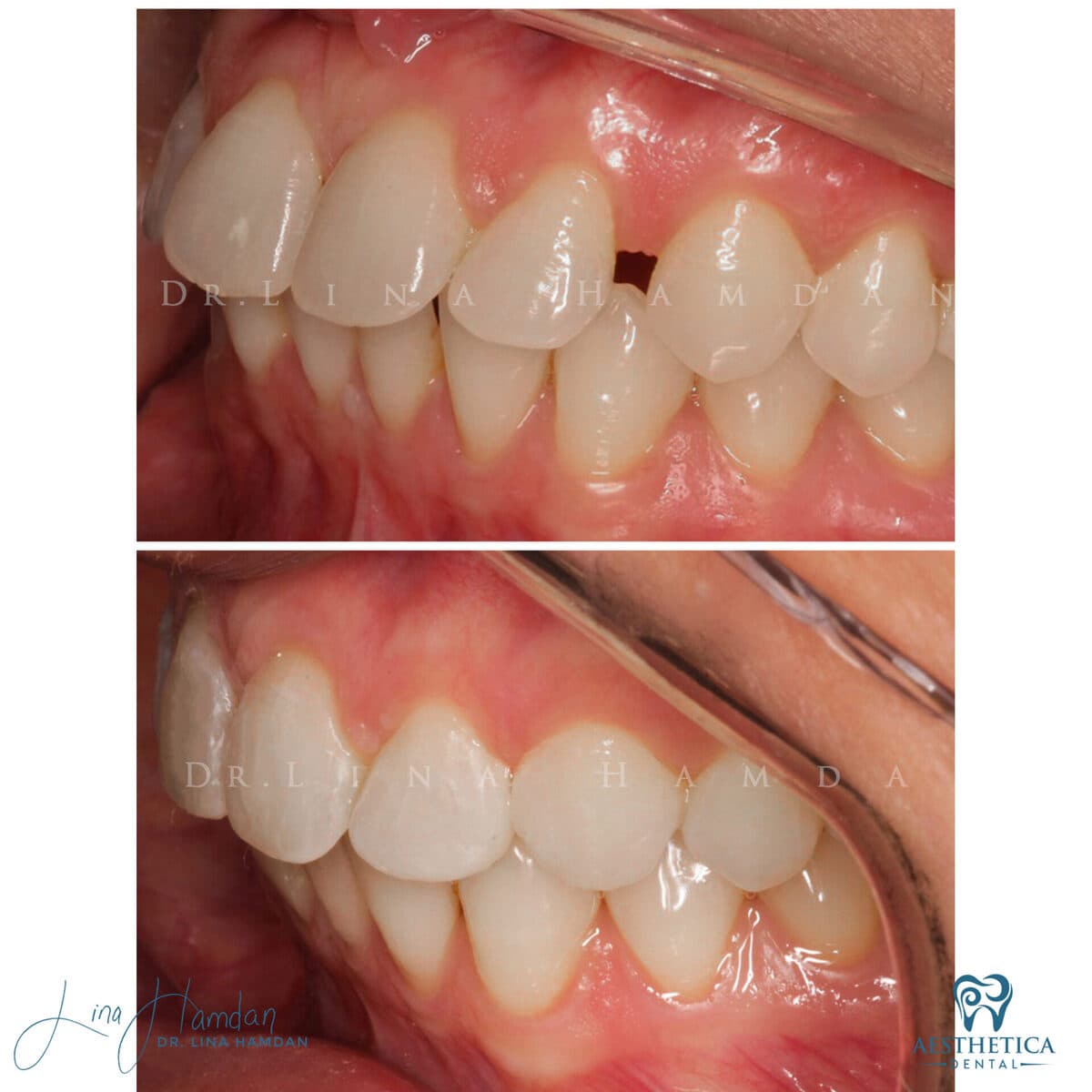 Inman aligners: anonymous case 34 from Aesthetica Dental Naperville