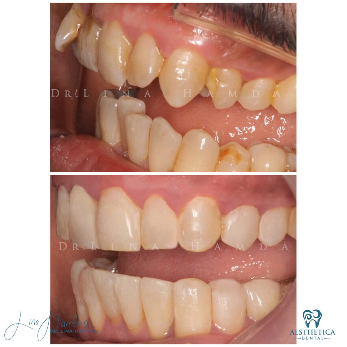 Inman aligners: anonymous case 36 from Aesthetica Dental Naperville