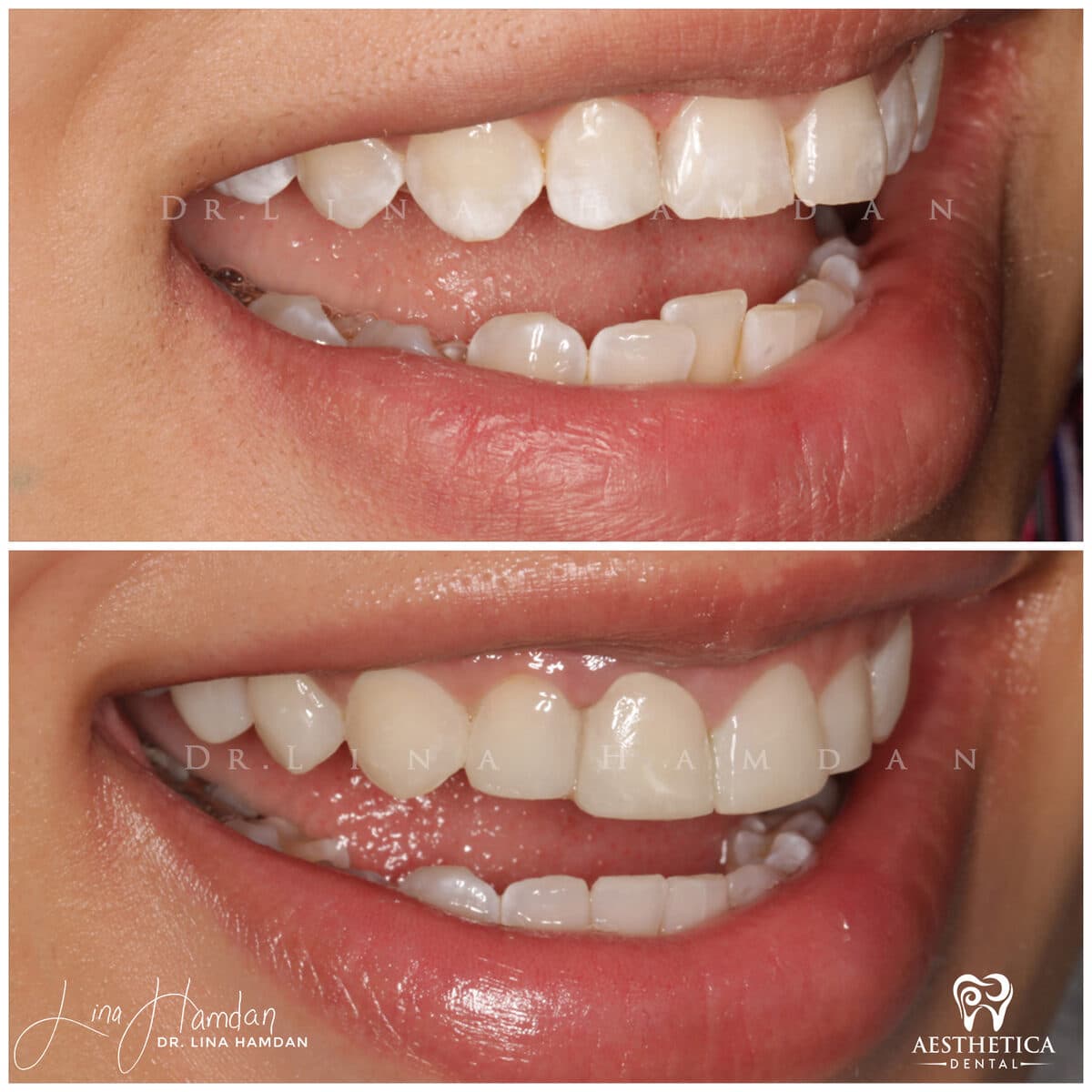 Inman aligners: anonymous case 40 from Aesthetica Dental Naperville