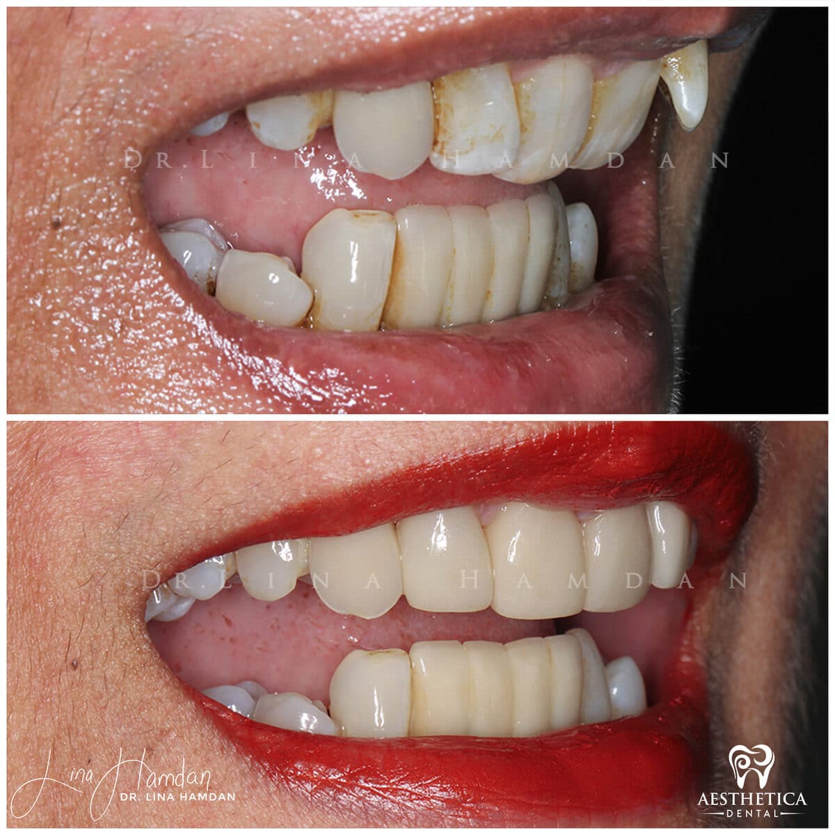 Inman aligners: anonymous case 41 from Aesthetica Dental Naperville