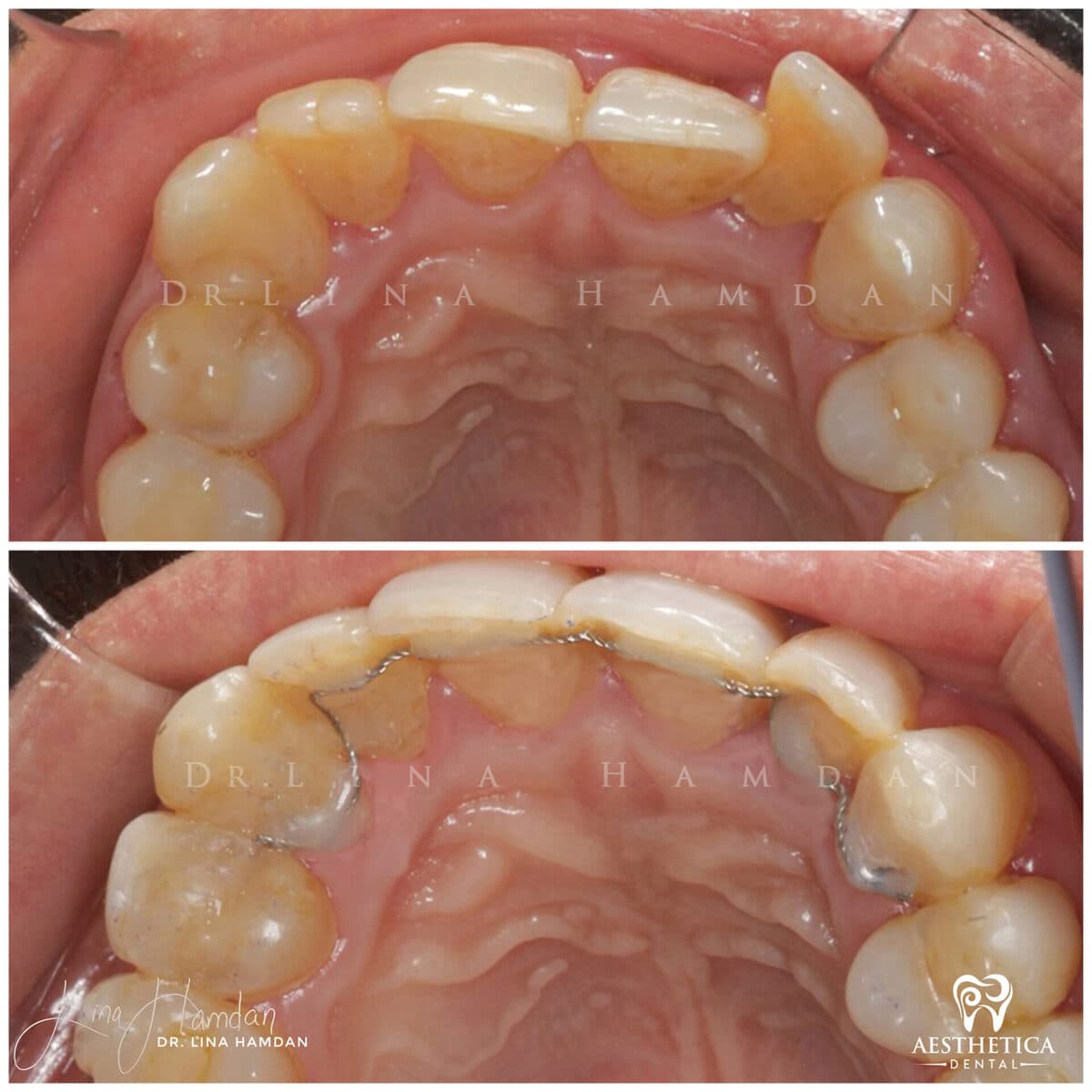 Inman aligners: anonymous case 42 from Aesthetica Dental Naperville