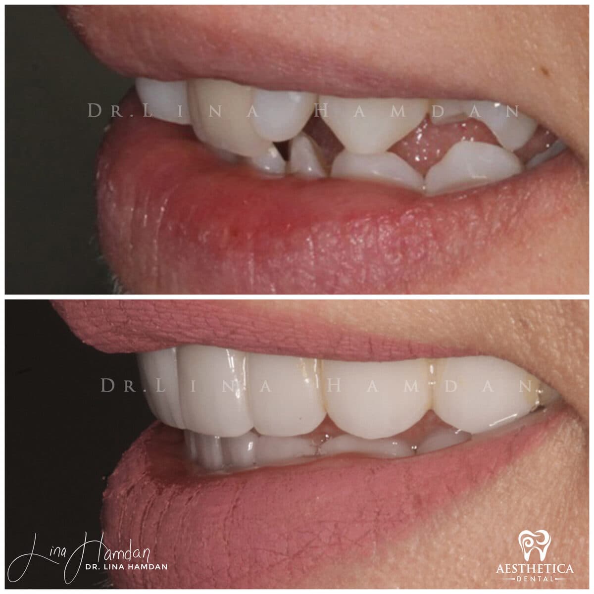 Inman aligners: anonymous case 45 from Aesthetica Dental Naperville