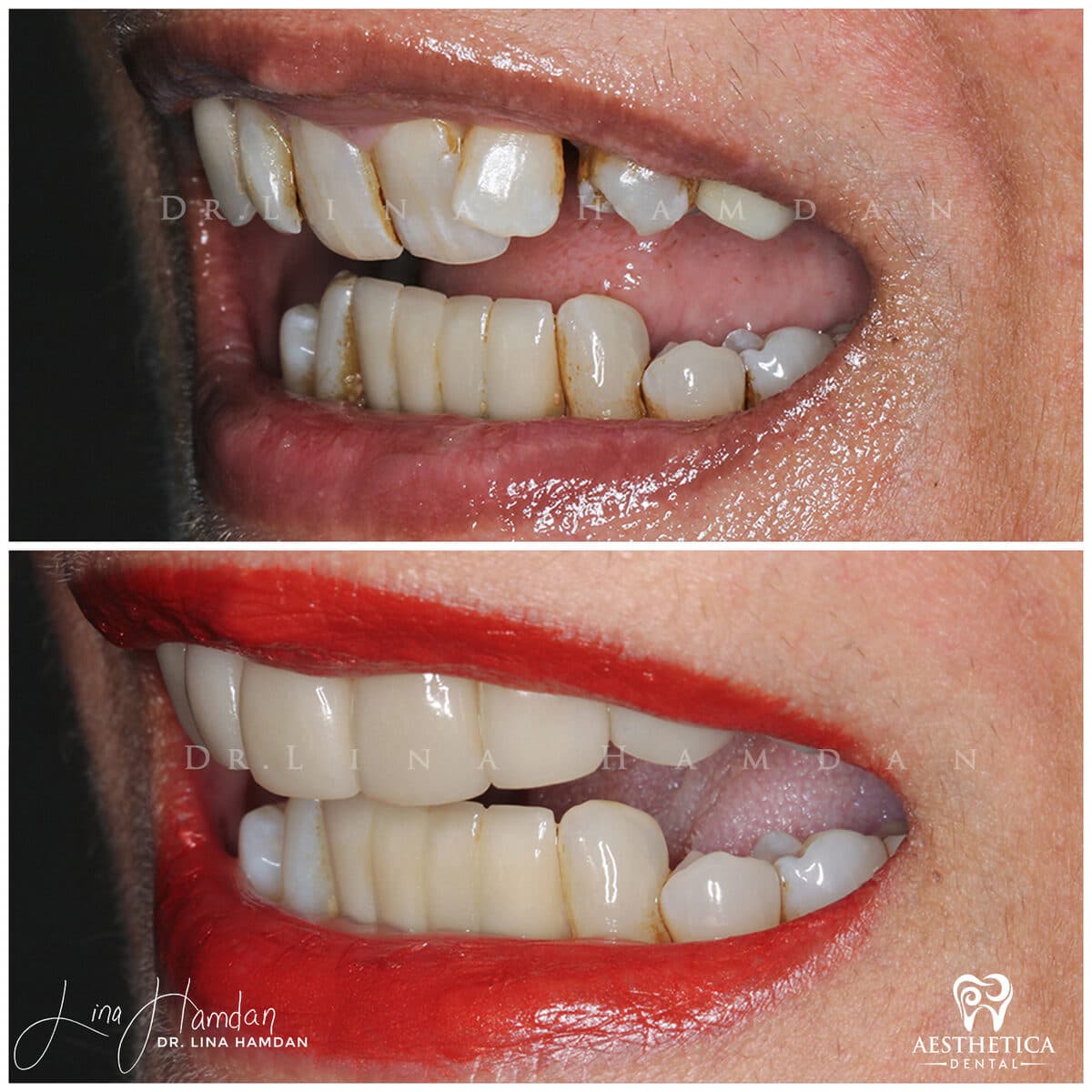 Inman aligners: anonymous case 48 from Aesthetica Dental Naperville