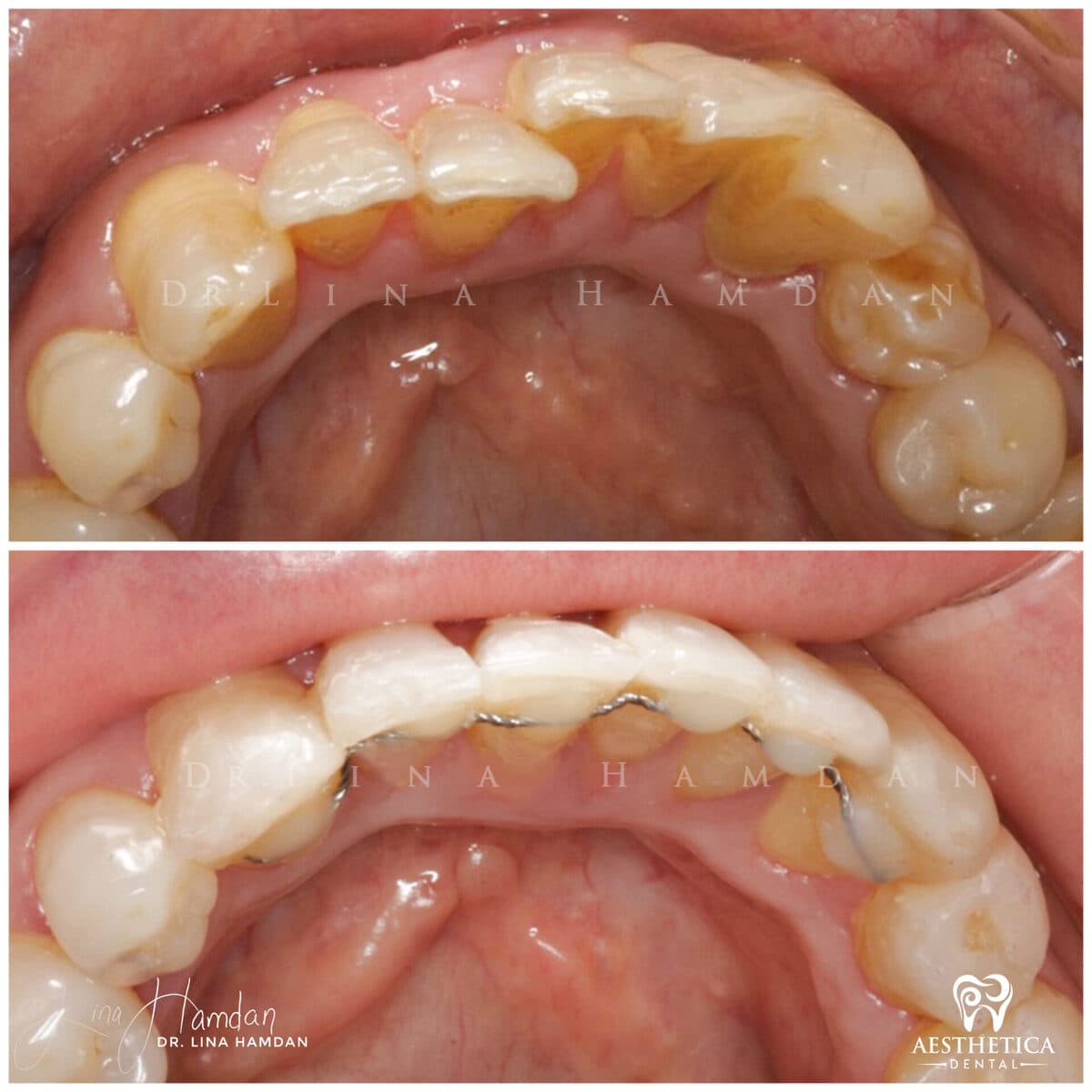 Inman aligners: anonymous case 49 from Aesthetica Dental Naperville