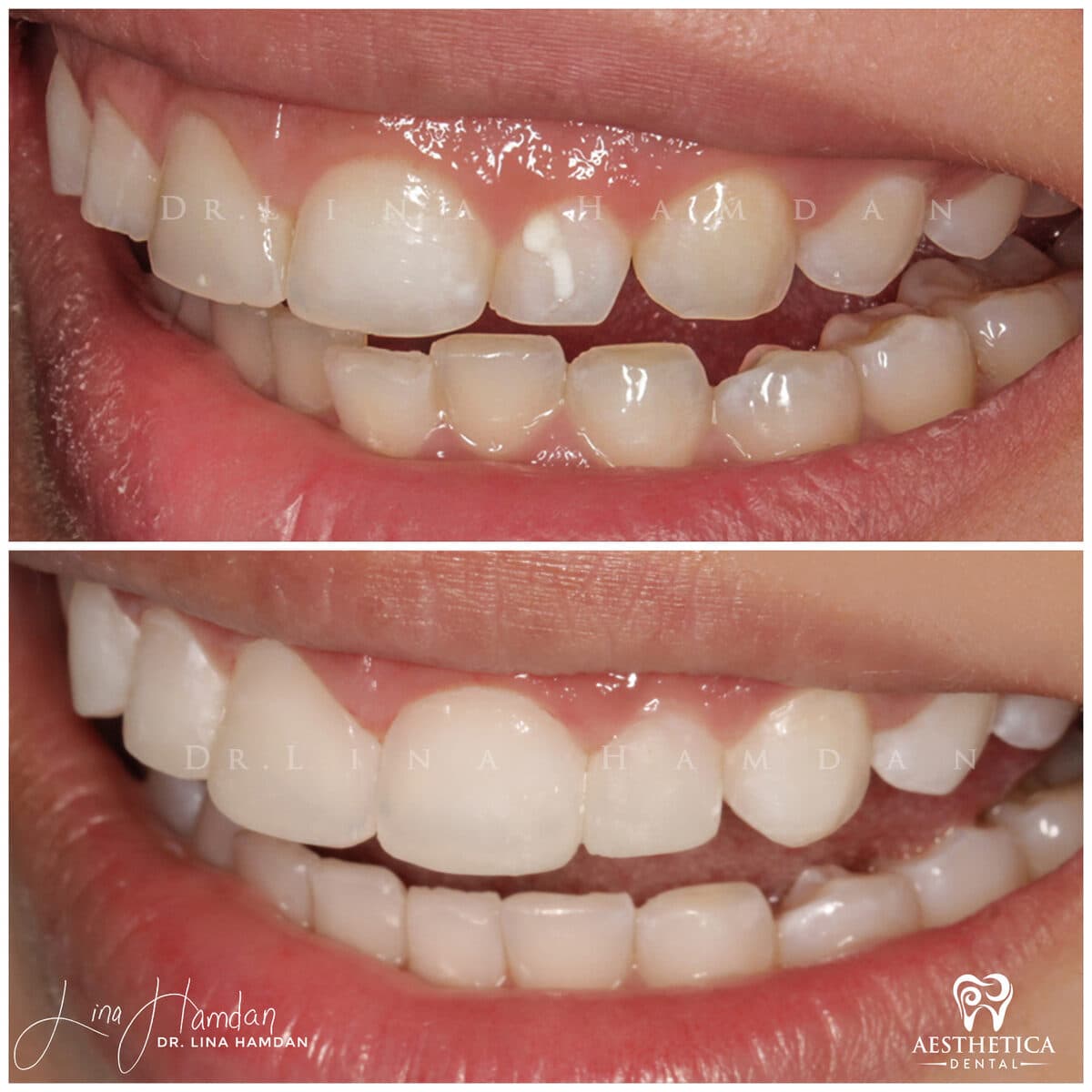 Inman aligners: anonymous case 51 from Aesthetica Dental Naperville