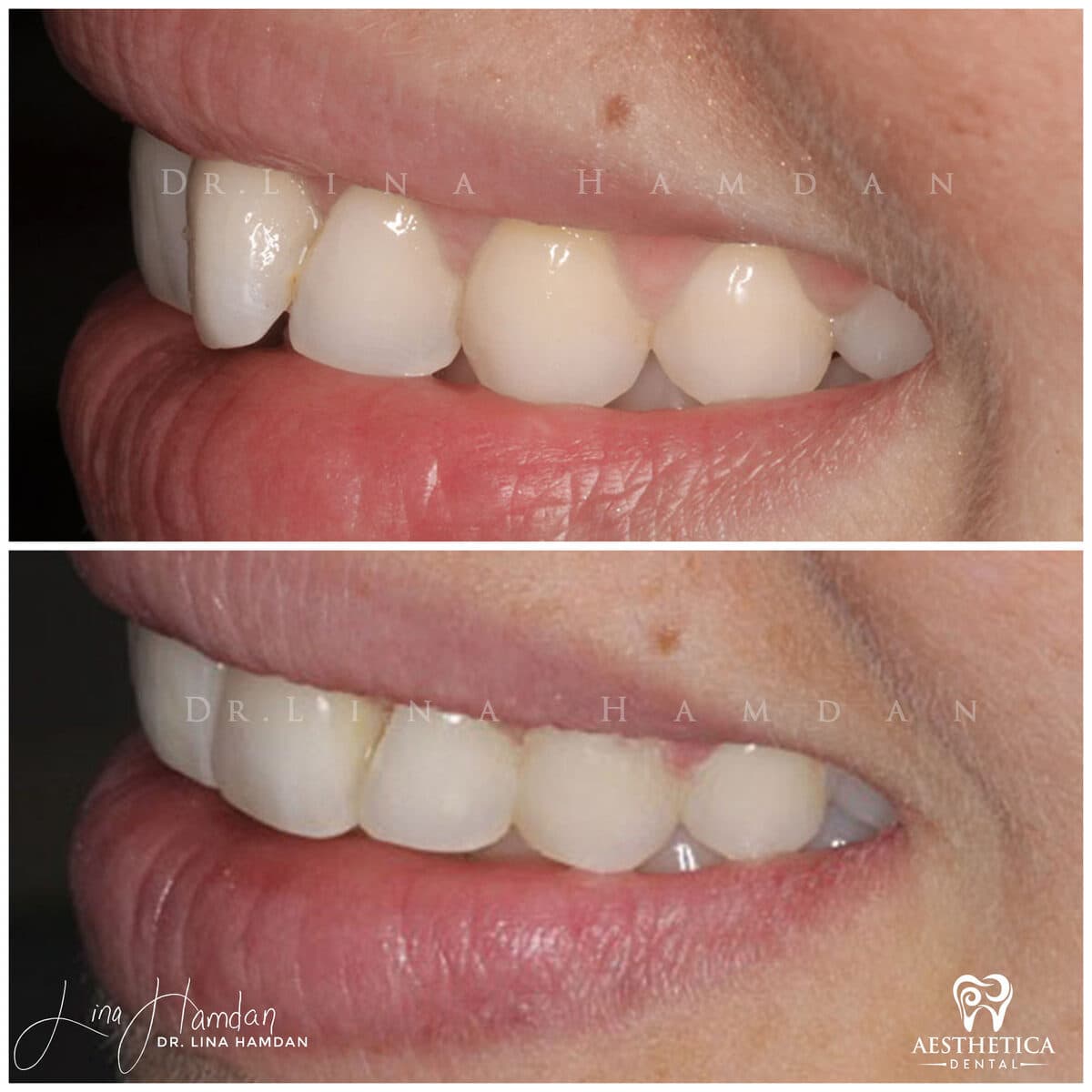 Inman aligners: anonymous case 57 from Aesthetica Dental Naperville