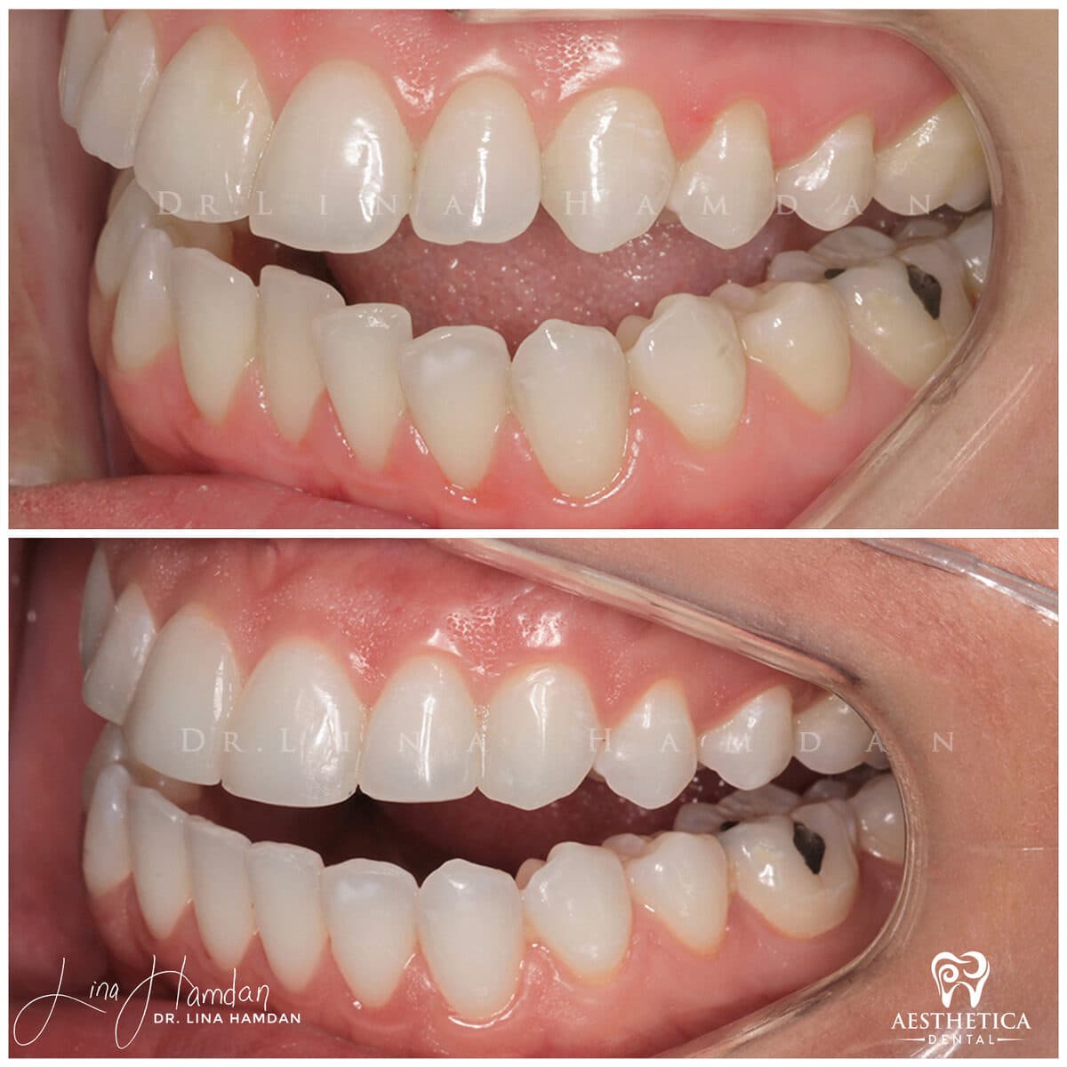 Inman aligners: anonymous case 58 from Aesthetica Dental Naperville