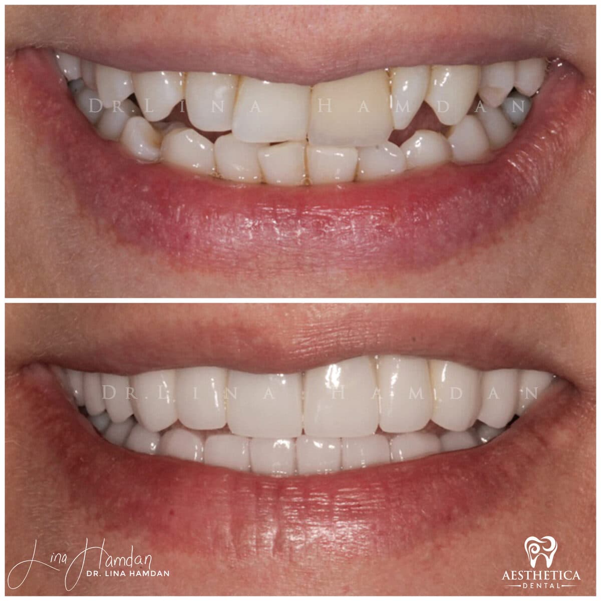 Inman aligners: anonymous case 59 from Aesthetica Dental Naperville