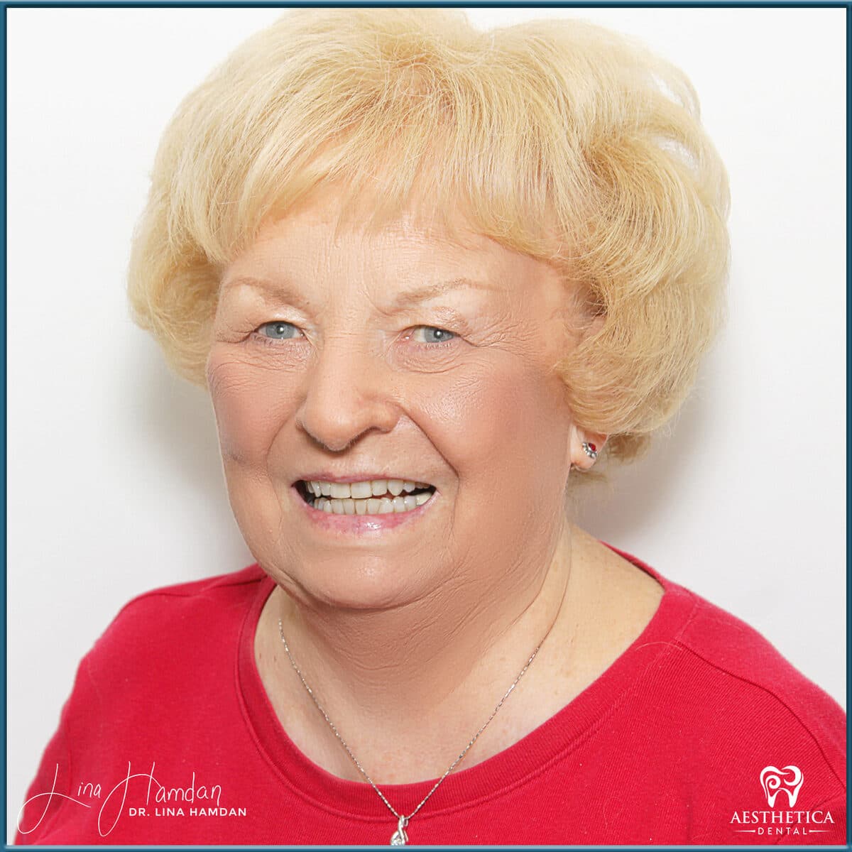 Inman aligners: anonymous case 64 from Aesthetica Dental Naperville
