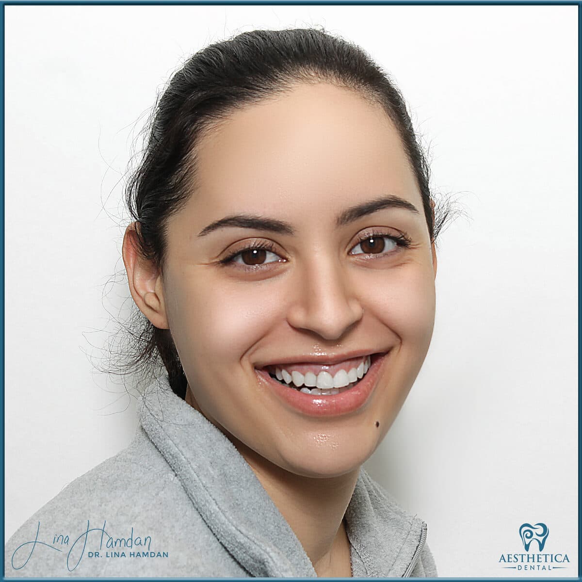 Inman aligners: anonymous case 67 from Aesthetica Dental Naperville
