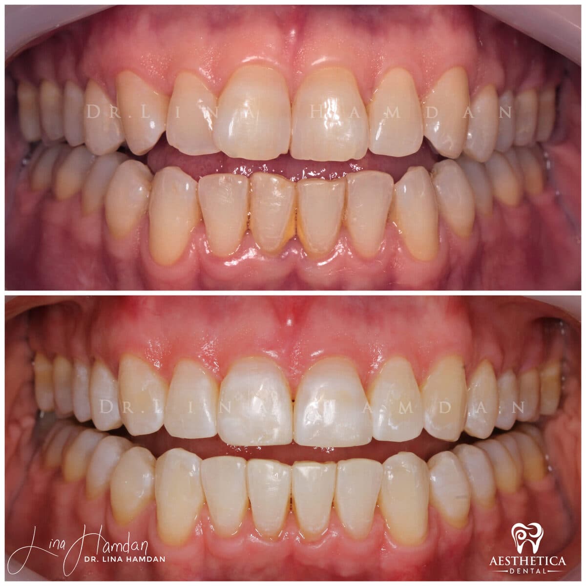 Invisalign clear aligner result, anonymous patient at Aesthetica Dental Naperville (case 2, 2025-01-1-8)