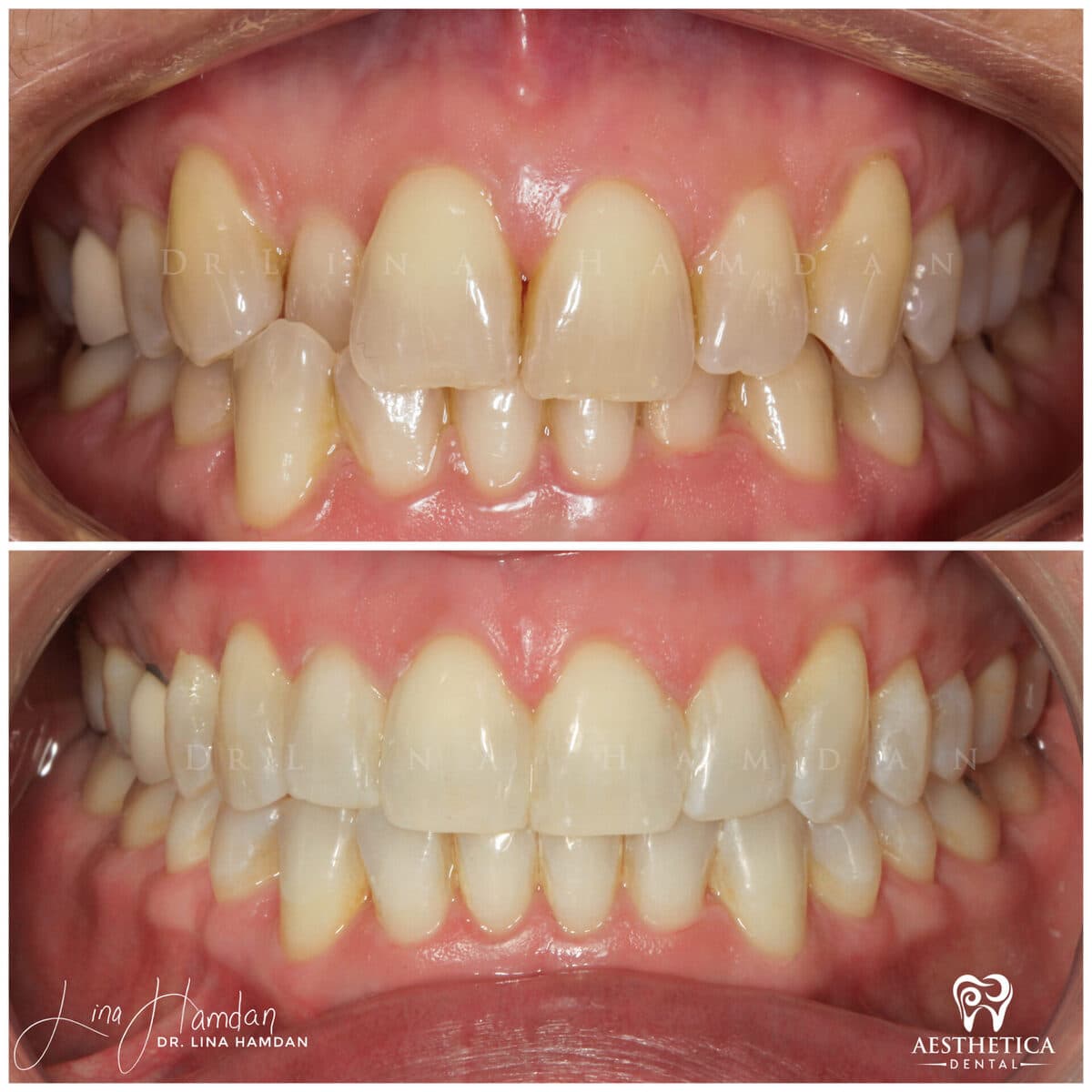 Invisalign clear aligner result, anonymous patient at Aesthetica Dental Naperville (case 3, 2025-01-10-7)