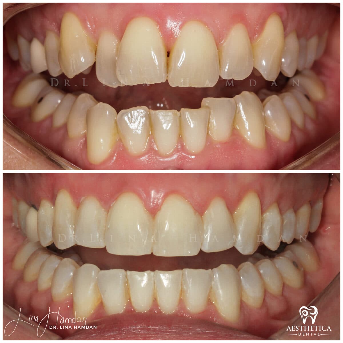 Invisalign clear aligner result, anonymous patient at Aesthetica Dental Naperville (case 4, 2025-01-11-6)