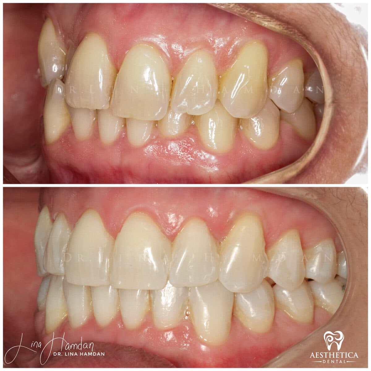 Invisalign clear aligner result, anonymous patient at Aesthetica Dental Naperville (case 7, 2025-01-14-3)