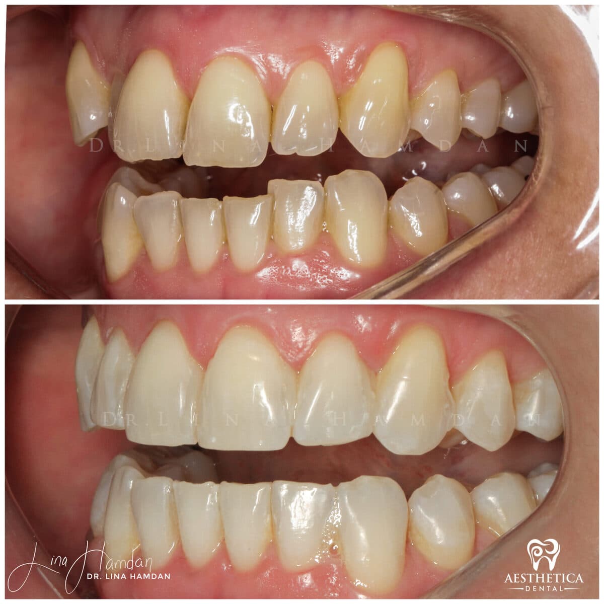 Invisalign clear aligner result, anonymous patient at Aesthetica Dental Naperville (case 8, 2025-01-15-3)