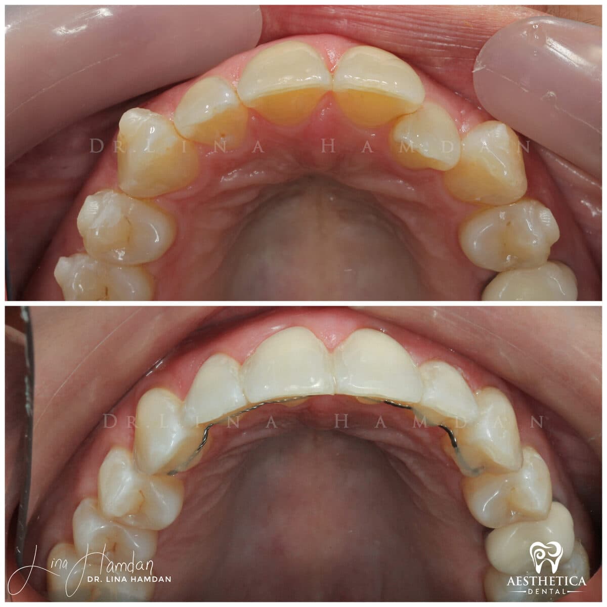 Invisalign clear aligner result, anonymous patient at Aesthetica Dental Naperville (case 9, 2025-01-16-2)