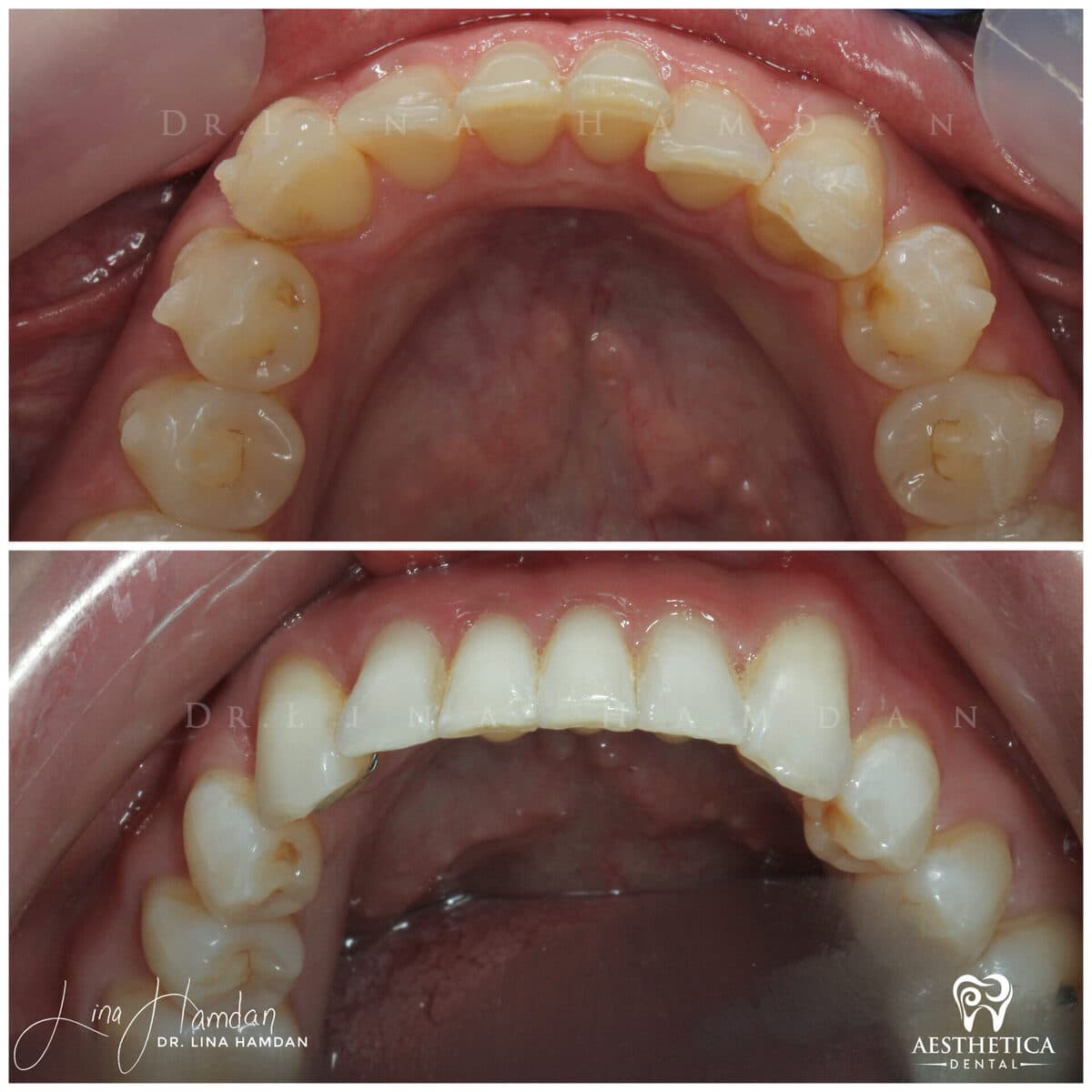 Invisalign clear aligner result, anonymous patient at Aesthetica Dental Naperville (case 10, 2025-01-17-2)