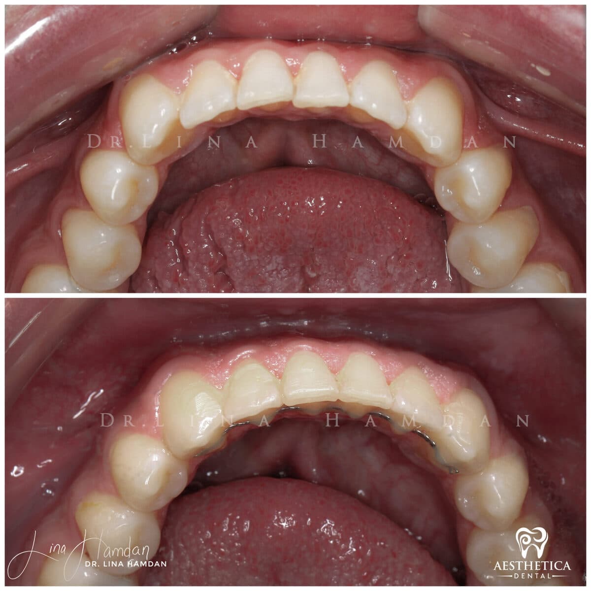 Invisalign clear aligner result, anonymous patient at Aesthetica Dental Naperville (case 12, 2025-01-18-1)