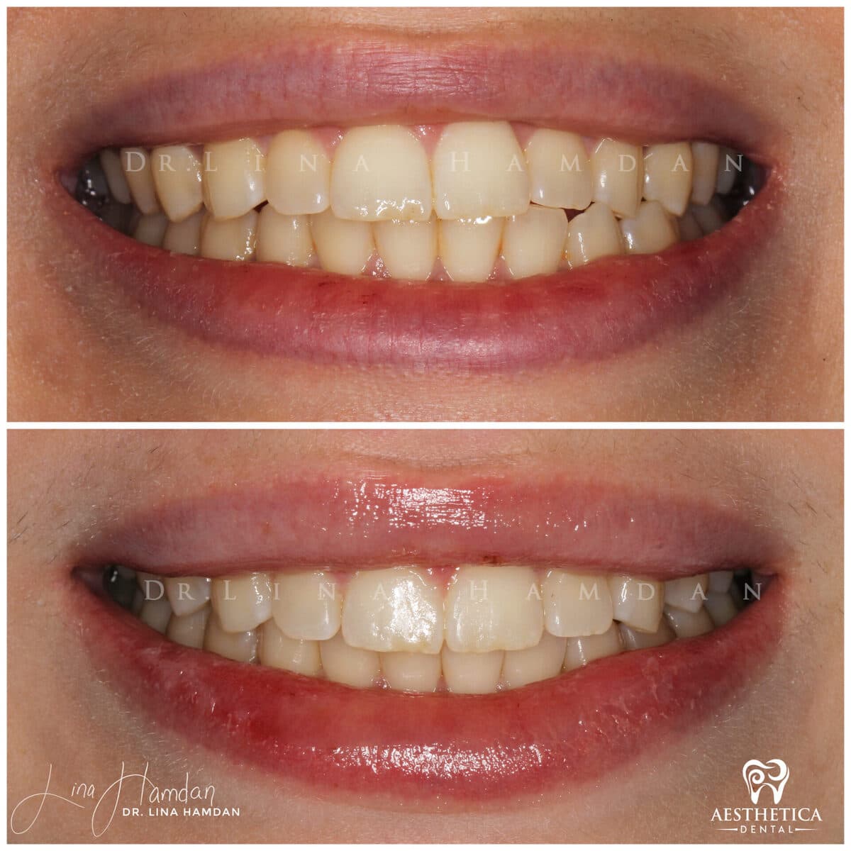 Clear aligners, quietly handled: anonymous case 14 from Aesthetica Dental Naperville