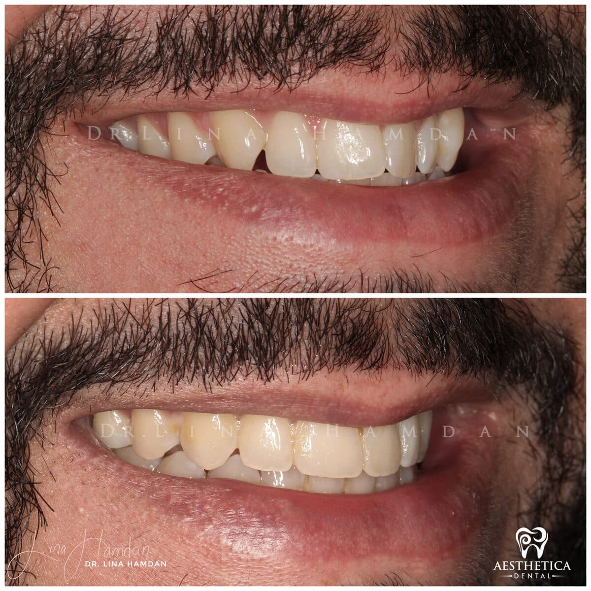 Clear aligners, quietly handled: anonymous case 15 from Aesthetica Dental Naperville