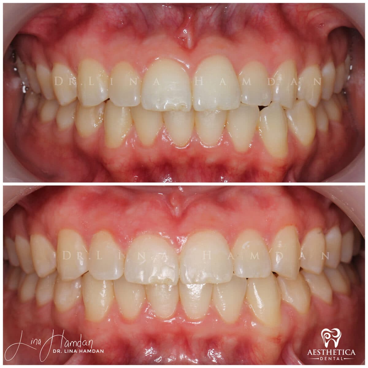 Clear aligners, quietly handled: anonymous case 22 from Aesthetica Dental Naperville