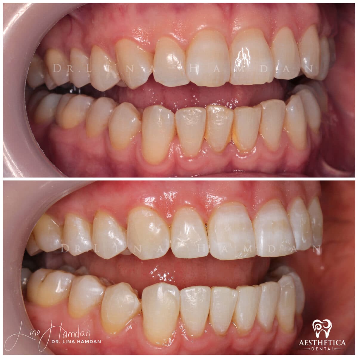Clear aligners, quietly handled: anonymous case 25 from Aesthetica Dental Naperville