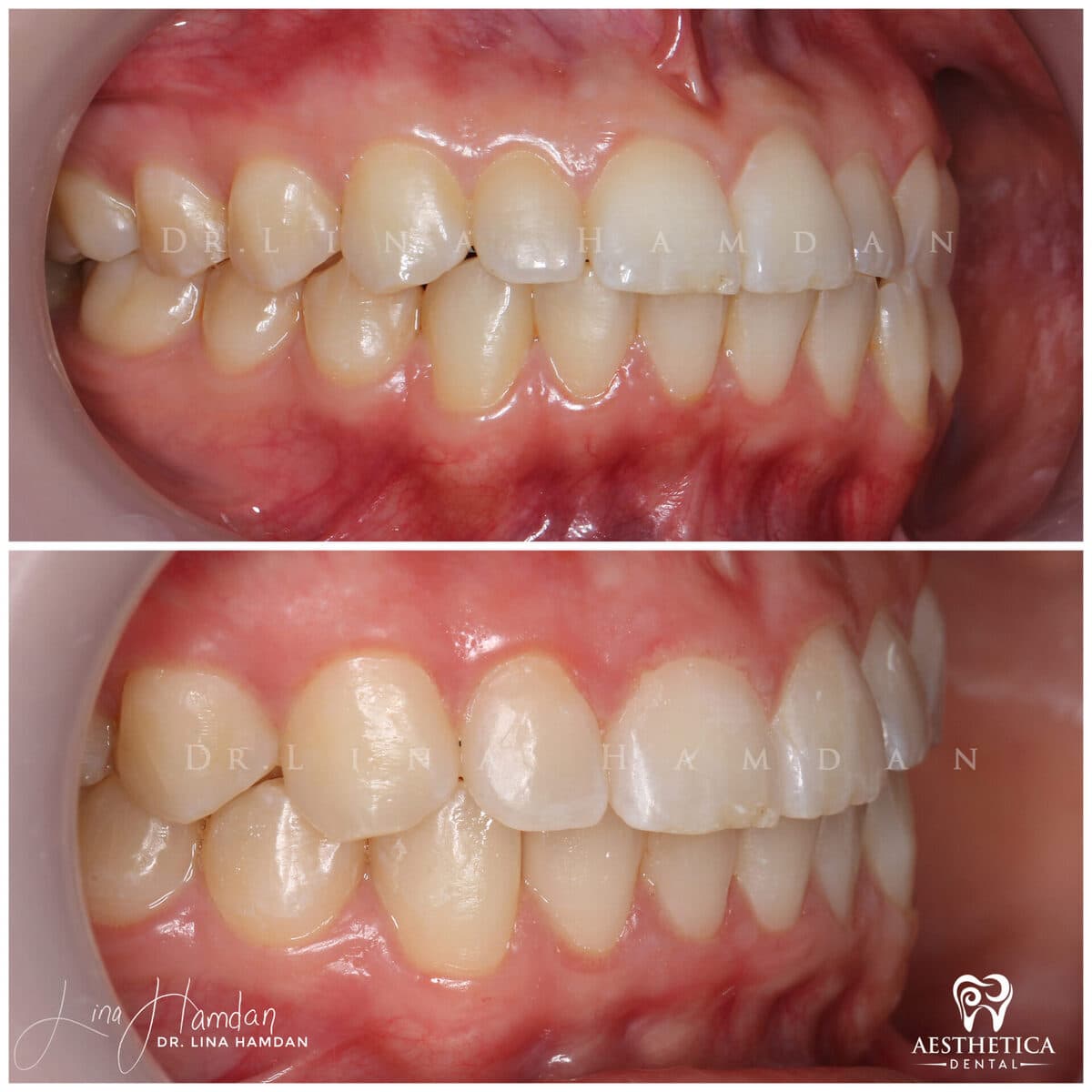 Clear aligners, quietly handled: anonymous case 27 from Aesthetica Dental Naperville