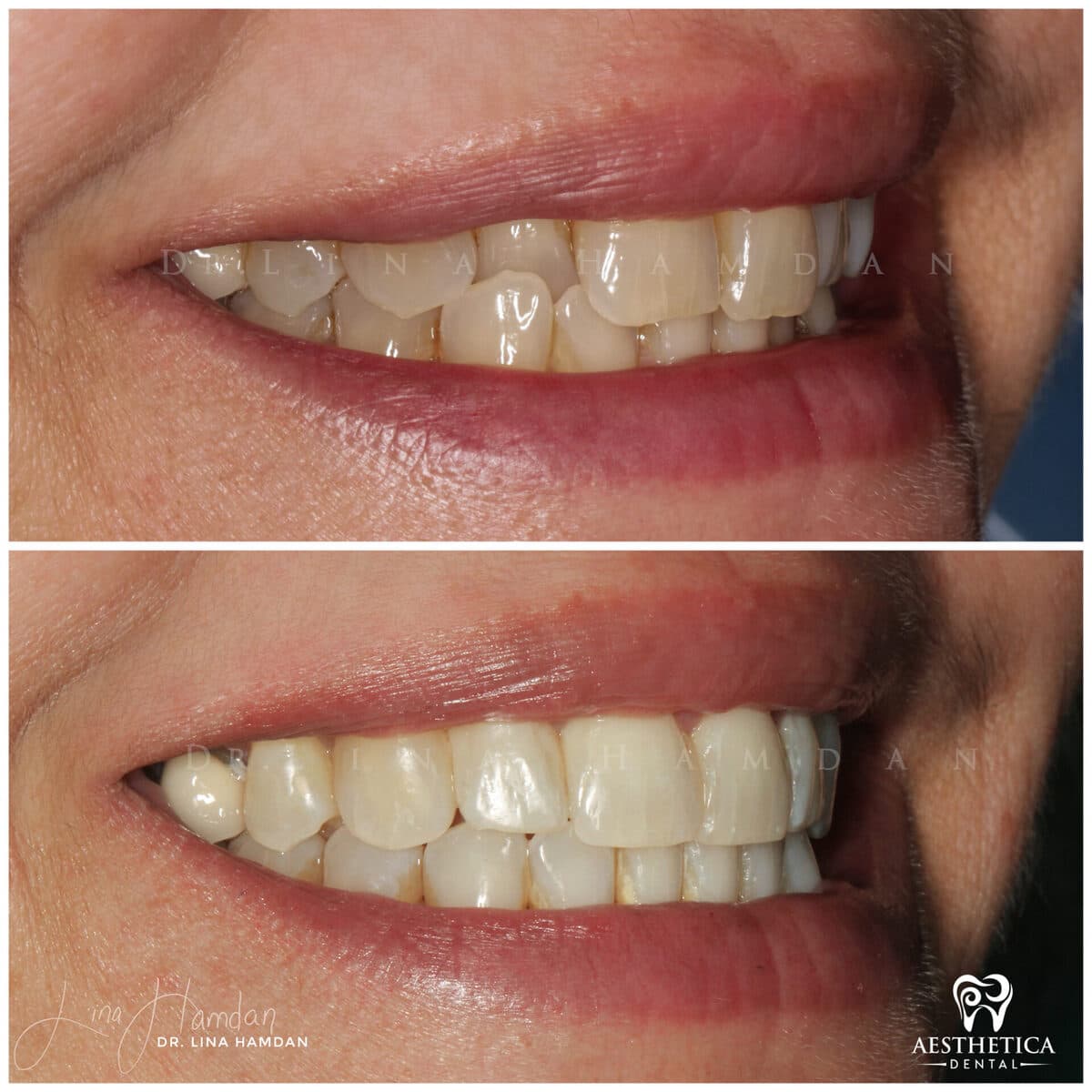 Clear aligners, quietly handled: anonymous case 28 from Aesthetica Dental Naperville