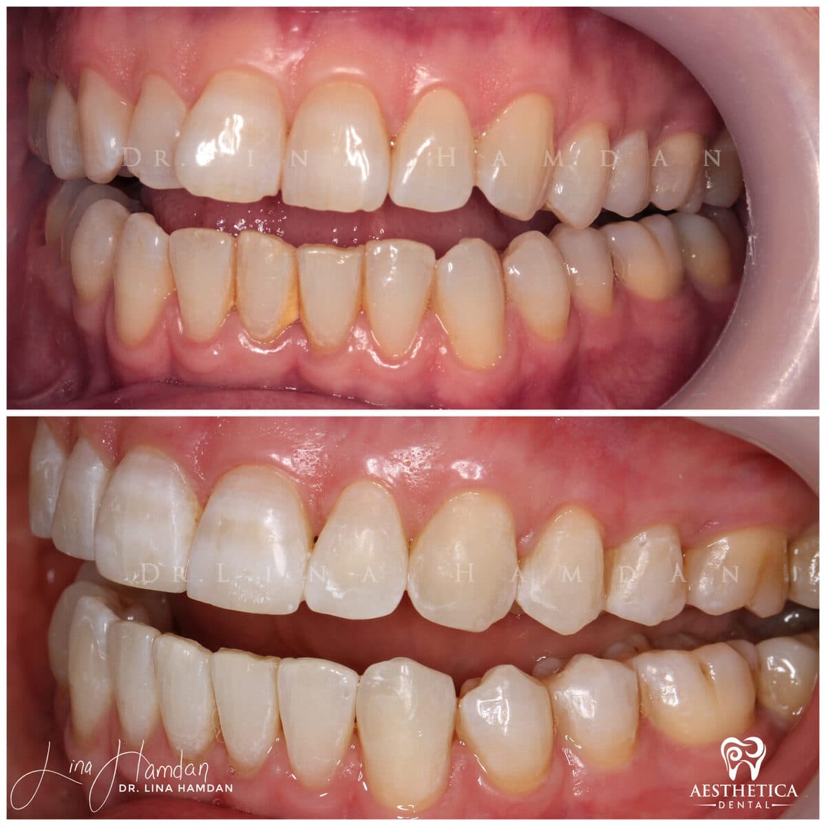 Clear aligners, quietly handled: anonymous case 29 from Aesthetica Dental Naperville