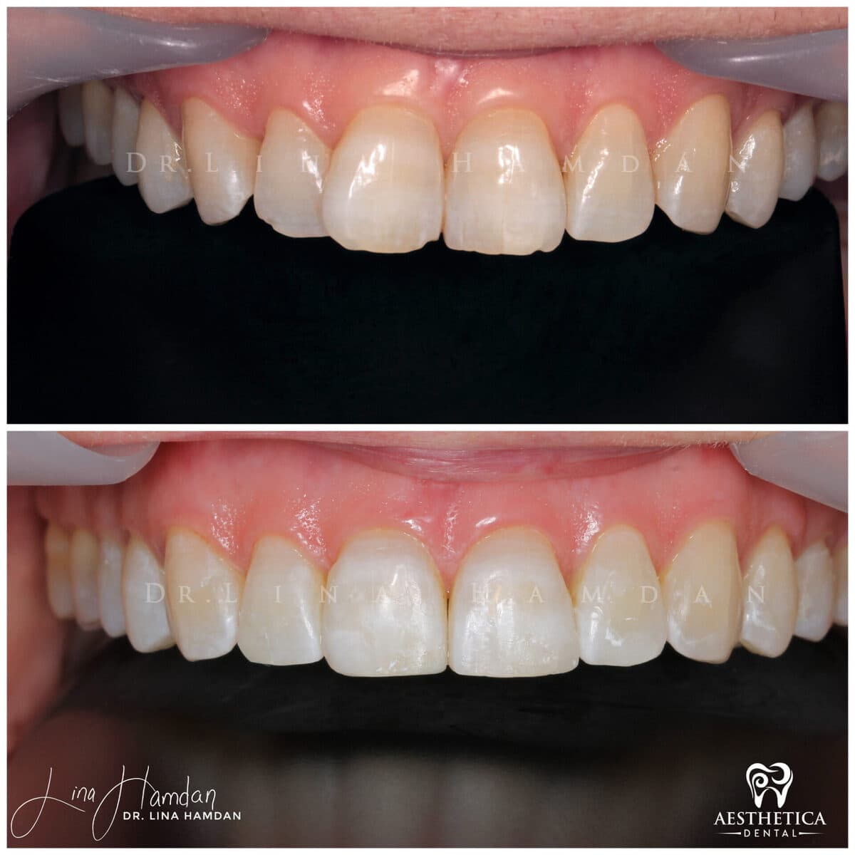 Clear aligners, quietly handled: anonymous case 31 from Aesthetica Dental Naperville