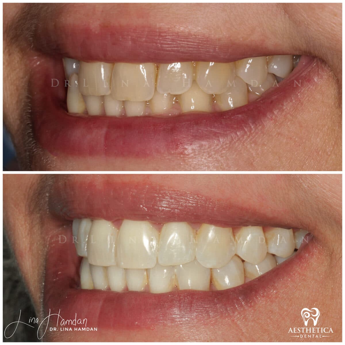Clear aligners, quietly handled: anonymous case 32 from Aesthetica Dental Naperville