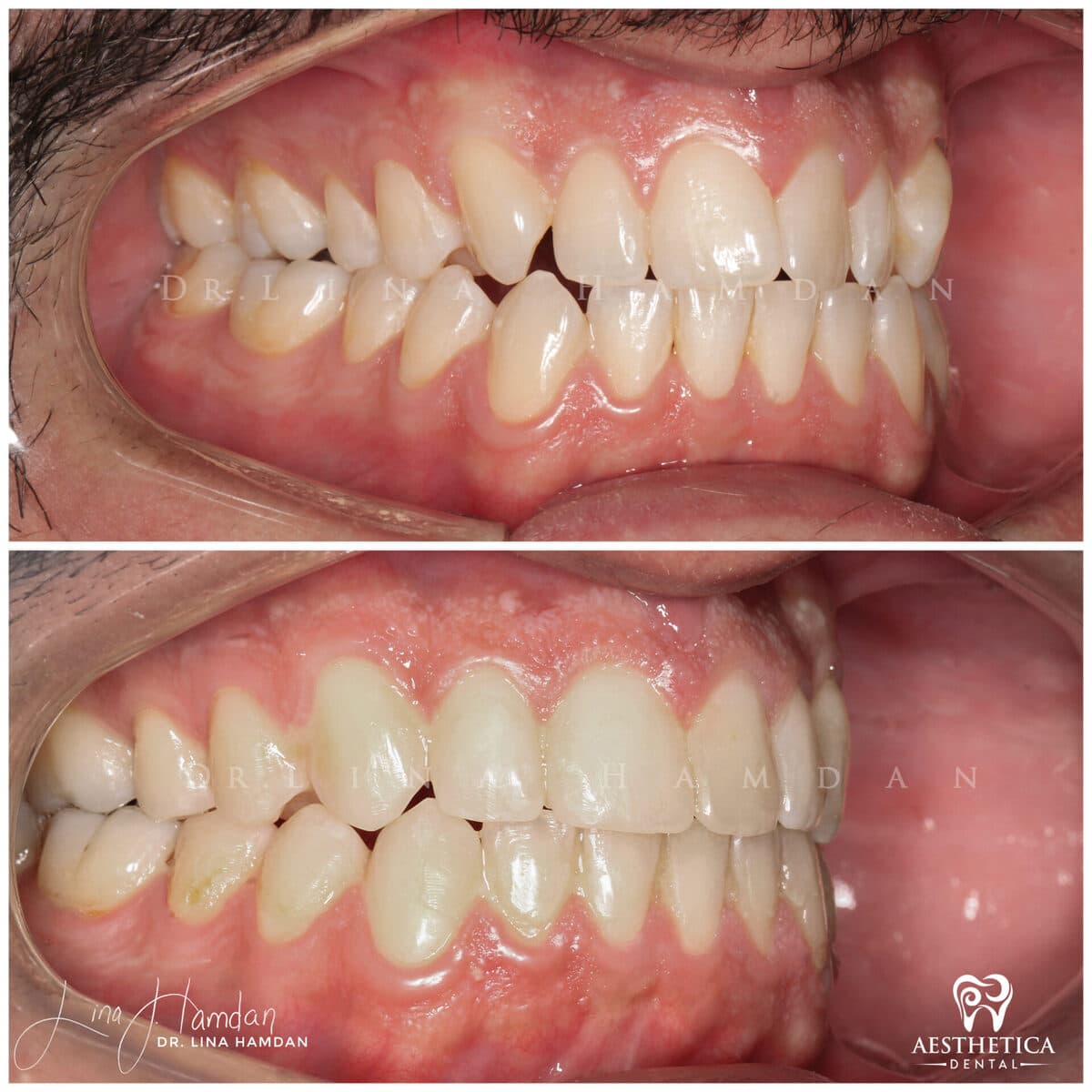 Clear aligners, quietly handled: anonymous case 33 from Aesthetica Dental Naperville