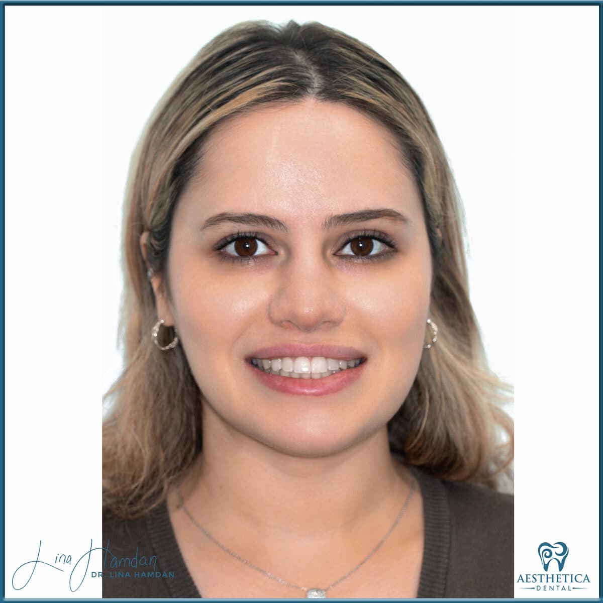 Clear aligners, quietly handled: anonymous case 37 from Aesthetica Dental Naperville