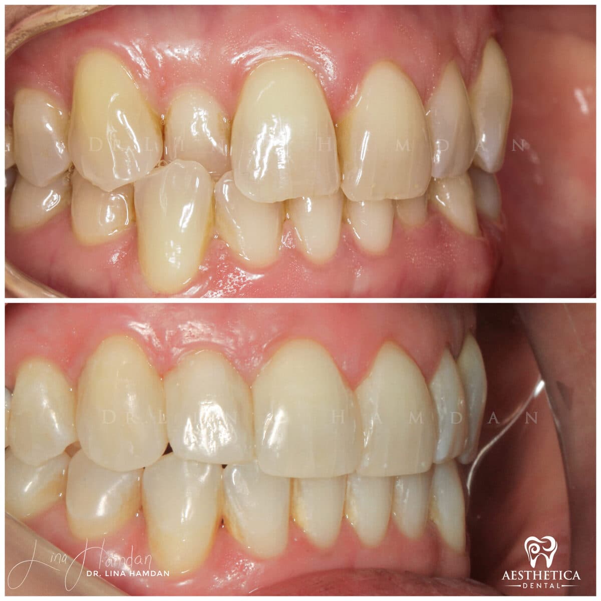 Clear aligners, quietly handled: anonymous case 43 from Aesthetica Dental Naperville