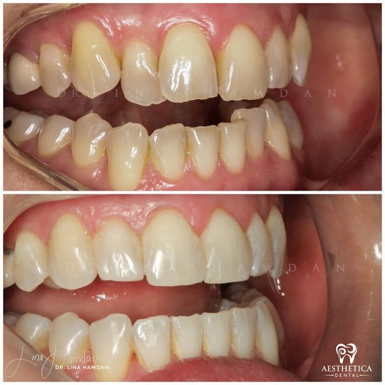 Clear aligners, quietly handled: anonymous case 44 from Aesthetica Dental Naperville