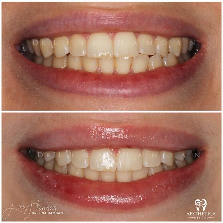 Clear aligners, quietly handled: anonymous case 51 from Aesthetica Dental Naperville