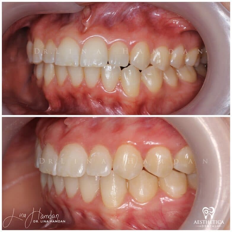 Clear aligners, quietly handled: anonymous case 54 from Aesthetica Dental Naperville