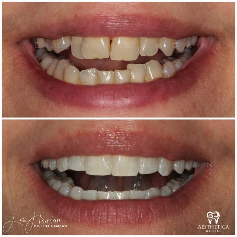 Clear aligners, quietly handled: anonymous case 56 from Aesthetica Dental Naperville
