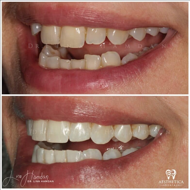 Clear aligners, quietly handled: anonymous case 61 from Aesthetica Dental Naperville